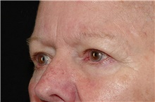 Eyelid Surgery Before Photo by Landon Pryor, MD, FACS; Rockford, IL - Case 38987