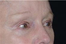 Eyelid Surgery After Photo by Landon Pryor, MD, FACS; Rockford, IL - Case 38987