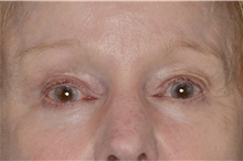 Eyelid Surgery After Photo by Landon Pryor, MD, FACS; Rockford, IL - Case 38987