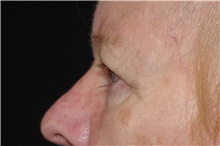 Eyelid Surgery Before Photo by Landon Pryor, MD, FACS; Rockford, IL - Case 38987
