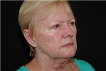 Facelift Before Photo by Landon Pryor, MD, FACS; Rockford, IL - Case 38988