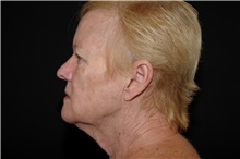 Facelift Before Photo by Landon Pryor, MD, FACS; Rockford, IL - Case 38988