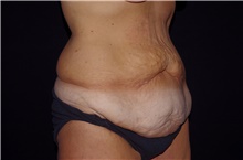 Tummy Tuck Before Photo by Landon Pryor, MD, FACS; Rockford, IL - Case 39024