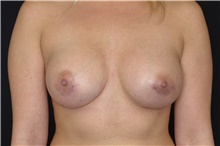 Breast Augmentation After Photo by Landon Pryor, MD, FACS; Rockford, IL - Case 39026