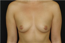 Breast Augmentation Before Photo by Landon Pryor, MD, FACS; Rockford, IL - Case 39026