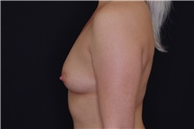Breast Augmentation Before Photo by Landon Pryor, MD, FACS; Rockford, IL - Case 39026
