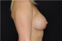Breast Augmentation After Photo by Landon Pryor, MD, FACS; Rockford, IL - Case 39026