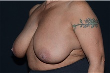 Breast Reduction Before Photo by Landon Pryor, MD, FACS; Rockford, IL - Case 39028