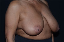 Breast Reduction Before Photo by Landon Pryor, MD, FACS; Rockford, IL - Case 39028
