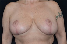 Breast Reduction After Photo by Landon Pryor, MD, FACS; Rockford, IL - Case 39028