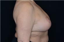Breast Reduction After Photo by Landon Pryor, MD, FACS; Rockford, IL - Case 39028