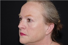 Brow Lift After Photo by Landon Pryor, MD, FACS; Rockford, IL - Case 39033