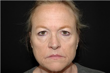 Brow Lift Before Photo by Landon Pryor, MD, FACS; Rockford, IL - Case 39033