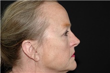 Brow Lift After Photo by Landon Pryor, MD, FACS; Rockford, IL - Case 39033