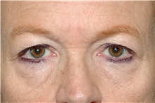 Eyelid Surgery Before Photo by Landon Pryor, MD, FACS; Rockford, IL - Case 39034