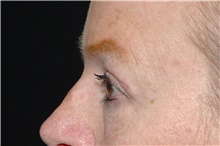 Eyelid Surgery After Photo by Landon Pryor, MD, FACS; Rockford, IL - Case 39034