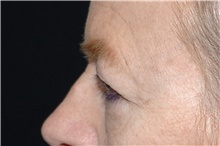 Eyelid Surgery Before Photo by Landon Pryor, MD, FACS; Rockford, IL - Case 39034