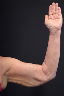 Arm Lift Before Photo by Landon Pryor, MD, FACS; Rockford, IL - Case 39069