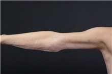 Arm Lift After Photo by Landon Pryor, MD, FACS; Rockford, IL - Case 39069