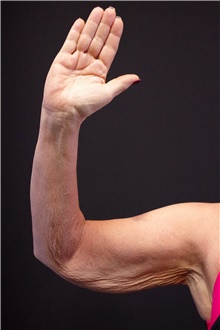 Arm Lift Before Photo by Landon Pryor, MD, FACS; Rockford, IL - Case 39069