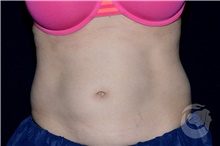 Body Contouring After Photo by Landon Pryor, MD, FACS; Rockford, IL - Case 39252