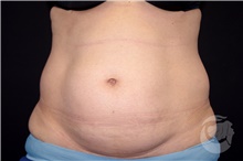 Body Contouring Before Photo by Landon Pryor, MD, FACS; Rockford, IL - Case 39252