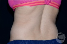 Body Contouring After Photo by Landon Pryor, MD, FACS; Rockford, IL - Case 39252