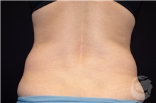 Body Contouring Before Photo by Landon Pryor, MD, FACS; Rockford, IL - Case 39252