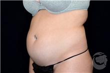 Liposuction Before Photo by Landon Pryor, MD, FACS; Rockford, IL - Case 39682