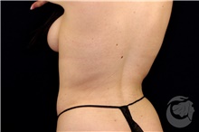 Liposuction After Photo by Landon Pryor, MD, FACS; Rockford, IL - Case 39682