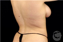 Liposuction After Photo by Landon Pryor, MD, FACS; Rockford, IL - Case 39682