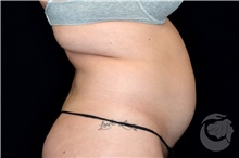 Liposuction Before Photo by Landon Pryor, MD, FACS; Rockford, IL - Case 39682