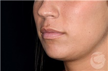 Lip Augmentation/Enhancement Before Photo by Landon Pryor, MD, FACS; Rockford, IL - Case 40028