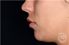 Lip Augmentation/Enhancement After Photo by Landon Pryor, MD, FACS; Rockford, IL - Case 40028