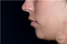 Lip Augmentation/Enhancement Before Photo by Landon Pryor, MD, FACS; Rockford, IL - Case 40028