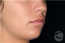 Lip Augmentation/Enhancement After Photo by Landon Pryor, MD, FACS; Rockford, IL - Case 40028