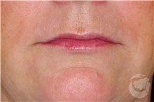 Lip Augmentation/Enhancement After Photo by Landon Pryor, MD, FACS; Rockford, IL - Case 40029