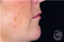 Lip Augmentation/Enhancement After Photo by Landon Pryor, MD, FACS; Rockford, IL - Case 40029