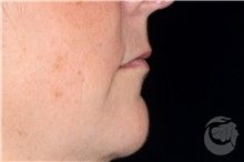 Lip Augmentation/Enhancement Before Photo by Landon Pryor, MD, FACS; Rockford, IL - Case 40029