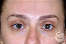 Dermal Fillers Before Photo by Landon Pryor, MD, FACS; Rockford, IL - Case 40030