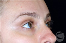 Dermal Fillers Before Photo by Landon Pryor, MD, FACS; Rockford, IL - Case 40030