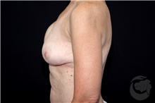 Breast Implant Revision Before Photo by Landon Pryor, MD, FACS; Rockford, IL - Case 40100