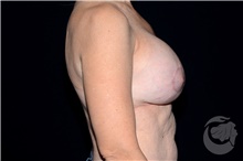 Breast Implant Revision After Photo by Landon Pryor, MD, FACS; Rockford, IL - Case 40100