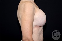 Breast Implant Revision Before Photo by Landon Pryor, MD, FACS; Rockford, IL - Case 40100