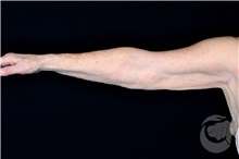 Arm Lift After Photo by Landon Pryor, MD, FACS; Rockford, IL - Case 40101