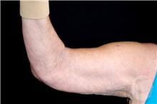Arm Lift Before Photo by Landon Pryor, MD, FACS; Rockford, IL - Case 40101