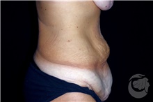 Tummy Tuck Before Photo by Landon Pryor, MD, FACS; Rockford, IL - Case 40103
