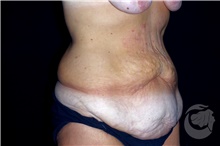Tummy Tuck Before Photo by Landon Pryor, MD, FACS; Rockford, IL - Case 40103