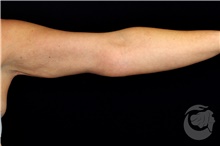 Arm Lift After Photo by Landon Pryor, MD, FACS; Rockford, IL - Case 40104