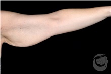 Arm Lift Before Photo by Landon Pryor, MD, FACS; Rockford, IL - Case 40104